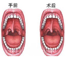 阴茎短小是什么疾病