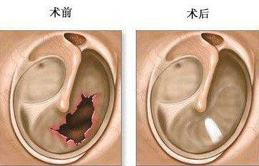 膀胱炎手术费用