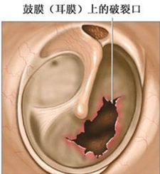 膀胱炎能坐飞机吗